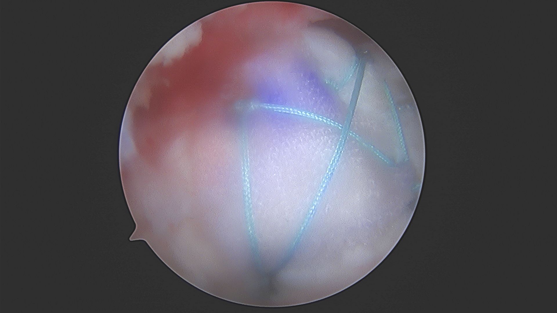 BioBrace:  Soft Tissue Reinforcement
